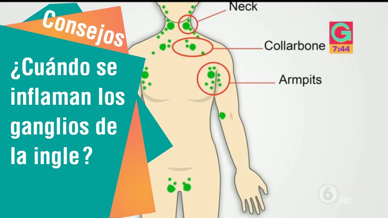 bulto en la ingle que se mueve