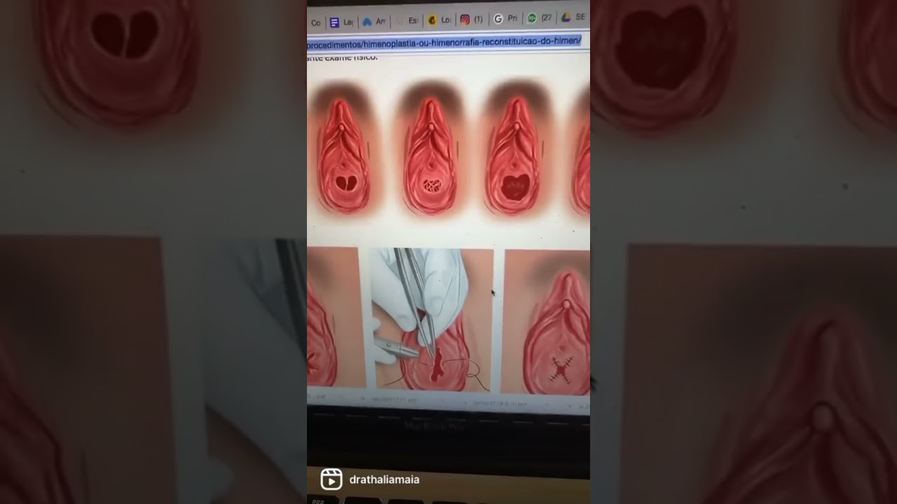 como se ve un himen normal