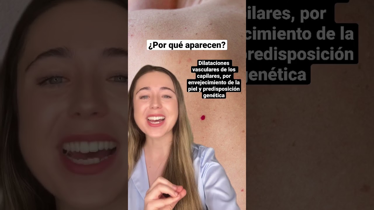 crema para eliminar lunares de sangre