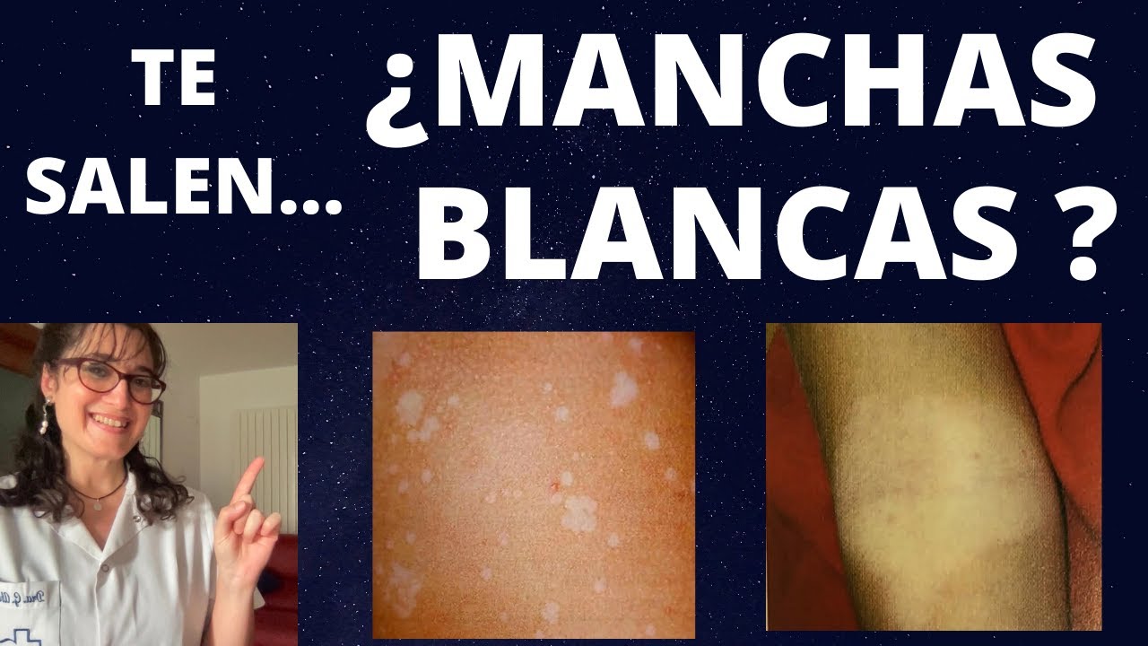 manchas blancas en la cara como quitarlas