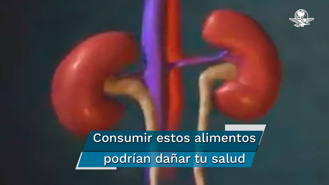 es malo el chocolate para el riñón