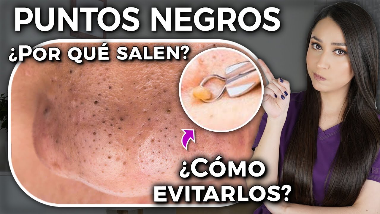 porque salen puntos negros en la nariz