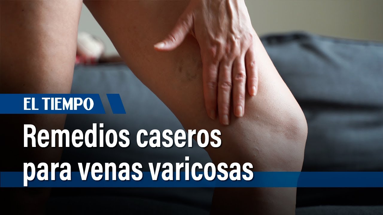 remedios caseros para piernas cansadas y con varices